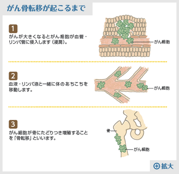 がん骨転移が起こるまで