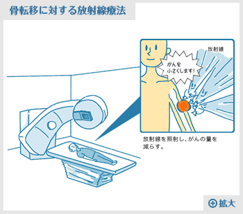 骨転移に対する放射線療法